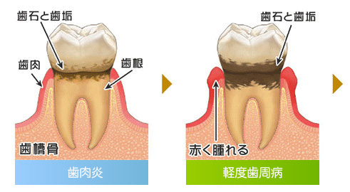 歯周病の症状