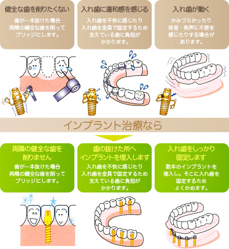 インプラント治療概念図